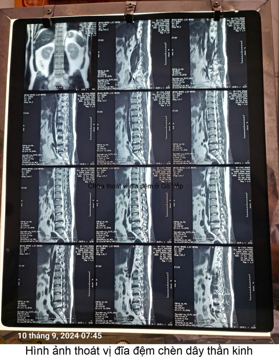 Thoát vị đĩa đệm chèn dây thần kinh